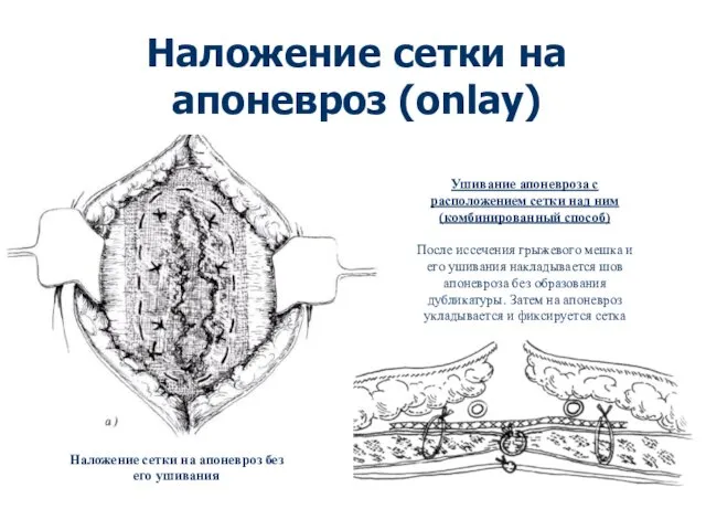 Наложение сетки на апоневроз (onlay) Наложение сетки на апоневроз без его