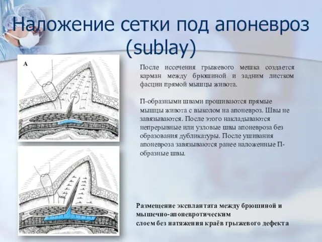 Наложение сетки под апоневроз (sublay) После иссечения грыжевого мешка создается карман