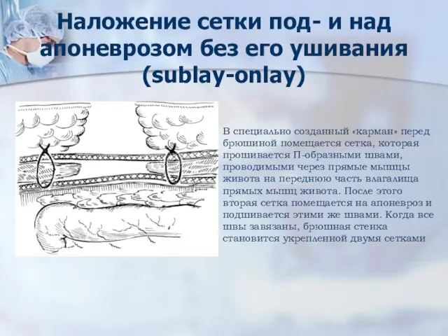 Наложение сетки под- и над апоневрозом без его ушивания (sublay-onlay) В