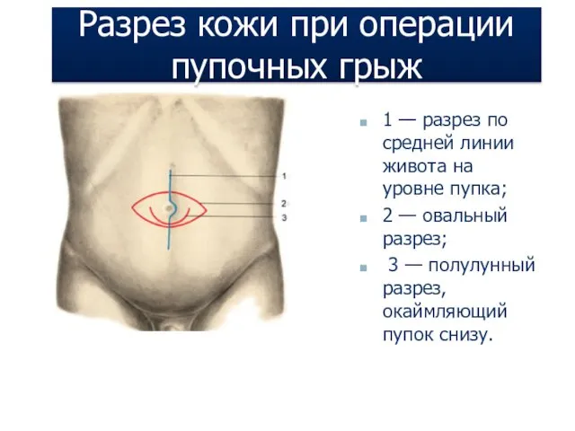 Разрез кожи при операции пупочных грыж 1 — разрез по средней