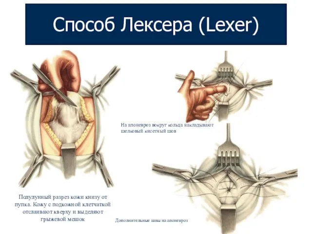 Способ Лексера (Lexer) Полулунный разрез кожи книзу от пупка. Кожу с