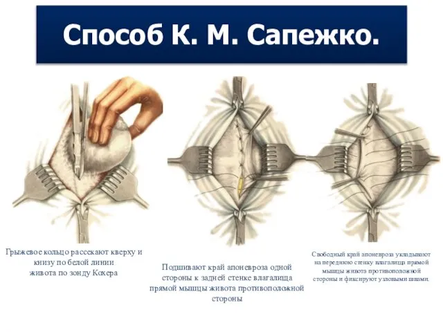 Способ К. М. Сапежко. Свободный край апоневроза укладывают на переднюю стенку