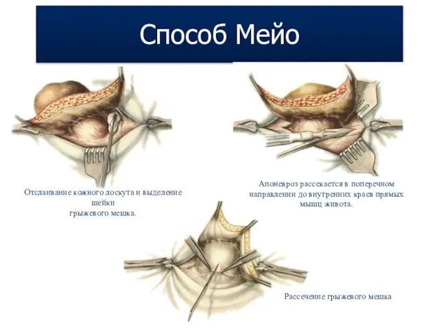 Отслаивание кожного лоскута и выделение шейки грыжевого мешка. Апоневроз рассекается в