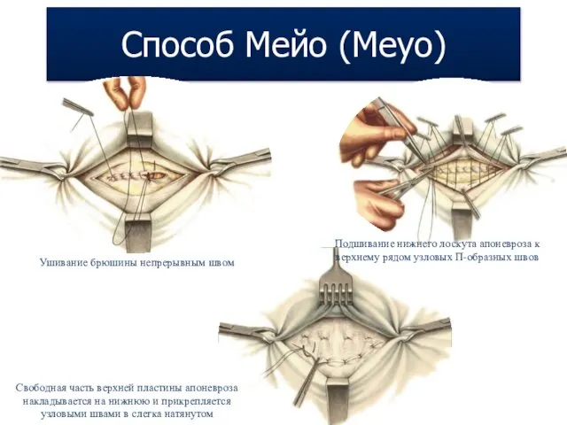 Способ Мейо (Meyo) Ушивание брюшины непрерывным швом Подшивание нижнего лоскута апоневроза