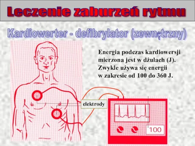 Leczenie zaburzeń rytmu Kardiowerter - defibrylator (zewnętrzny) Energia podczas kardiowersji mierzona