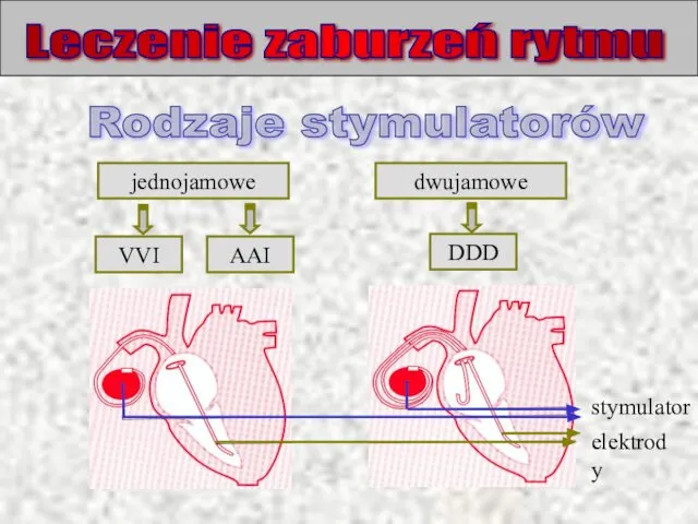 Leczenie zaburzeń rytmu Rodzaje stymulatorów jednojamowe dwujamowe VVI AAI DDD elektrody stymulator