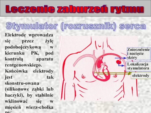 Leczenie zaburzeń rytmu Elektrodę wprowadza się przez żyłę podobojczykową w kierunku