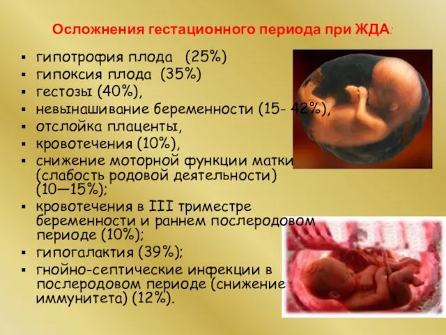 Осложнения гестационного периода при ЖДА: гипотрофия плода (25%) гипоксия плода (35%)