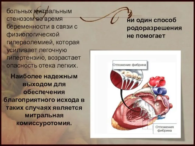 больных митральным стенозом во время беременности в связи с физиологической гиперволемией,