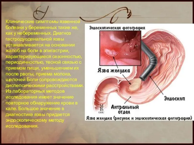 Клинические симптомы язвенной болезни у беременных такие же, как у небеременных.