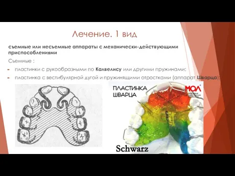 Лечение. 1 вид съемные или несъемные аппараты с механически-действующими приспособлениями Съемные