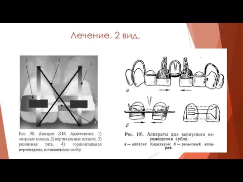 Лечение. 2 вид.