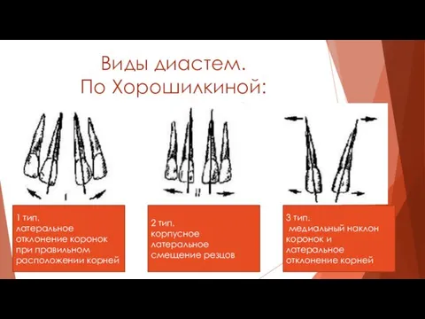 Виды диастем. По Хорошилкиной: 1 тип. латеральное отклонение коронок при правильном