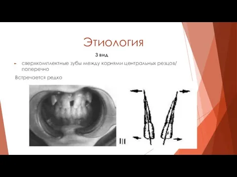 Этиология 3 вид сверхкомплектные зубы между корнями центральных резцов/ поперечно Встречается редко