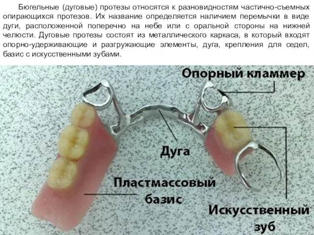 Бюгельные (дуговые) протезы относятся к разновидностям частично-съемных опирающихся протезов. Их название