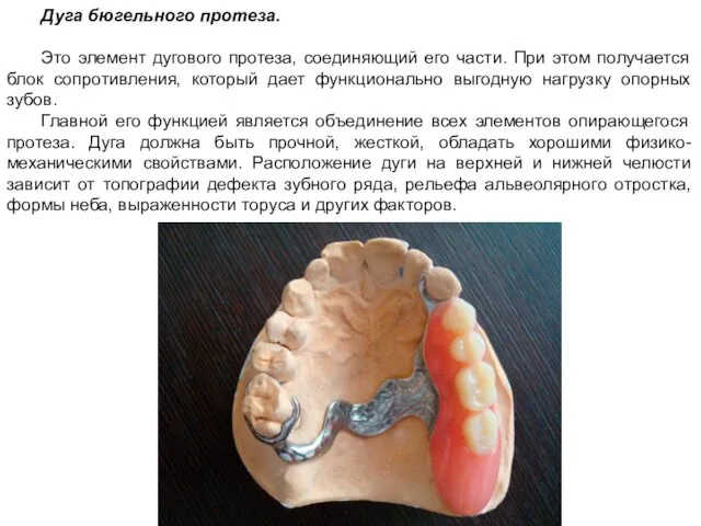 Дуга бюгельного протеза. Это элемент дугового протеза, соединяющий его части. При