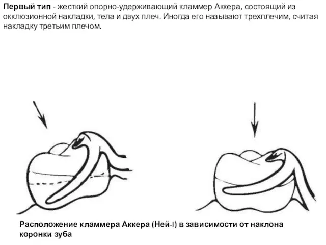 Первый тип - жесткий опорно-удерживающий кламмер Аккера, состоящий из окклюзионной накладки,