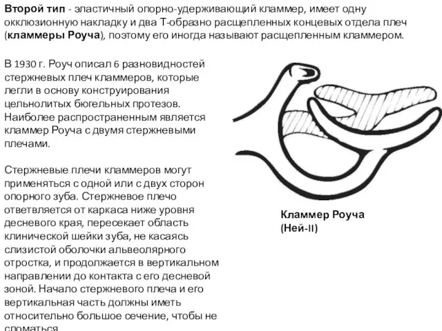 Второй тип - эластичный опорно-удерживающий кламмер, имеет одну окклюзионную накладку и