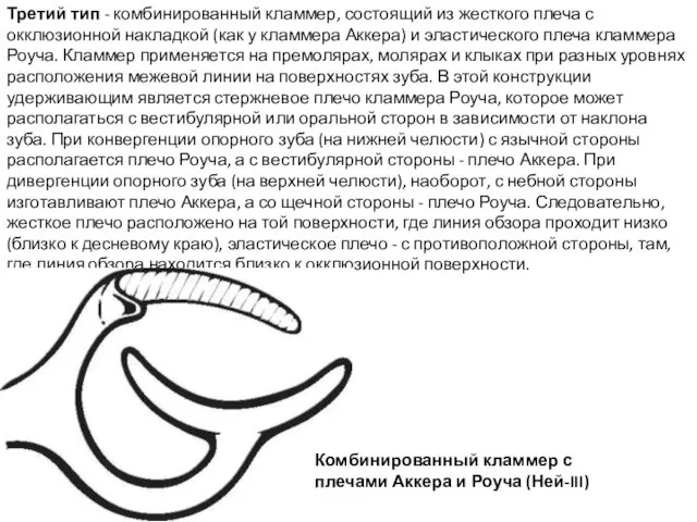 Третий тип - комбинированный кламмер, состоящий из жесткого плеча с окклюзионной