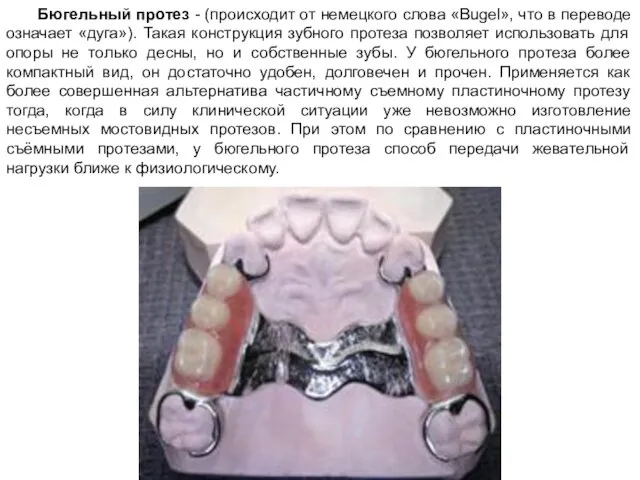 Бюгельный протез - (происходит от немецкого слова «Bugel», что в переводе