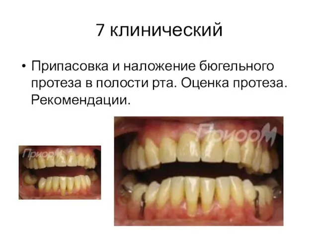 7 клинический Припасовка и наложение бюгельного протеза в полости рта. Оценка протеза. Рекомендации.