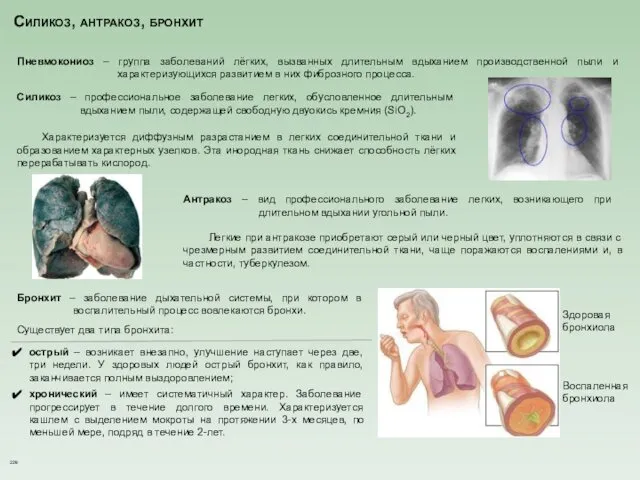 Силикоз, антракоз, бронхит Бронхит – заболевание дыхательной системы, при котором в