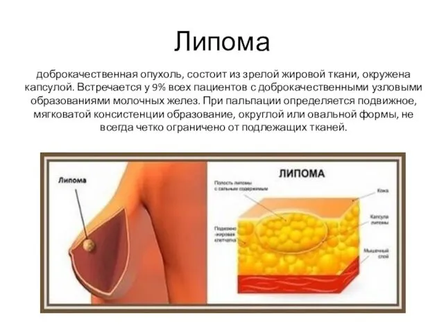 Липома доброкачественная опухоль, состоит из зрелой жировой ткани, окружена капсулой. Встречается