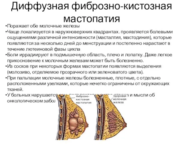 Диффузная фиброзно-кистозная мастопатия Поражает обе молочные железы Чаще локализуется в наружноверхних