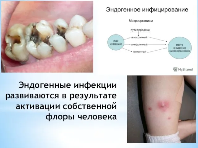 Эндогенные инфекции развиваются в результате активации собственной флоры человека