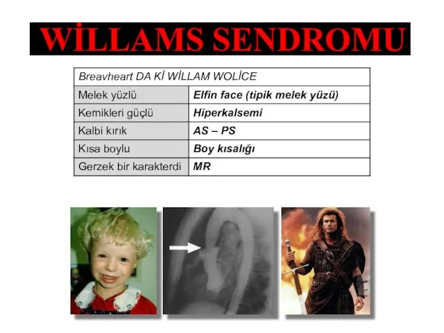 WİLLAMS SENDROMU