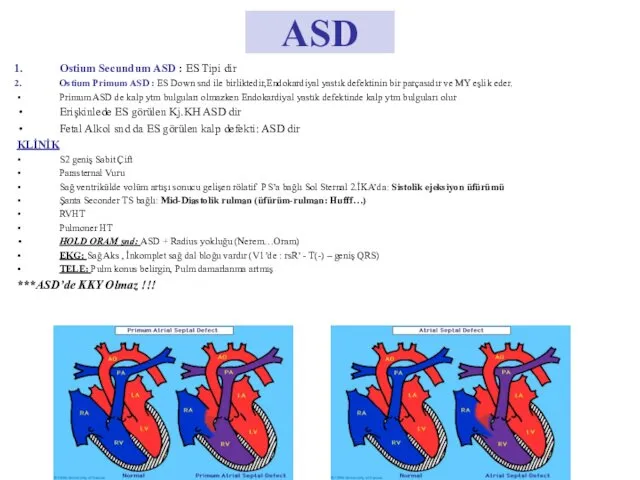 ASD Ostium Secundum ASD : ES Tipi dir Ostium Primum ASD