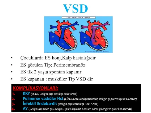 VSD Çocuklarda ES konj.Kalp hastalığıdır ES görülen Tip: Perimembranöz ES ilk