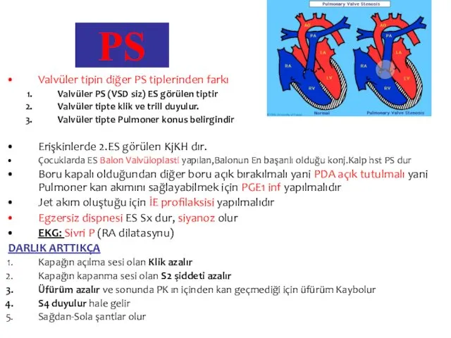 PS Valvüler tipin diğer PS tiplerinden farkı Valvüler PS (VSD siz)