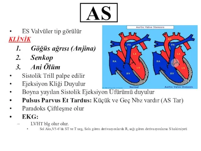 AS ES Valvüler tip görülür KLİNİK Göğüs ağrısı (Anjina) Senkop Ani