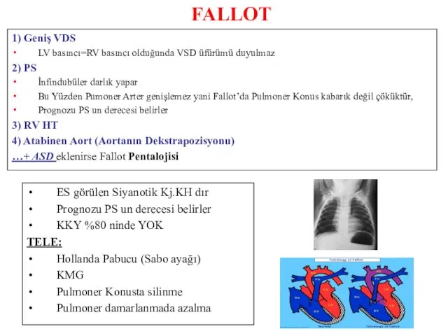 FALLOT ES görülen Siyanotik Kj.KH dır Prognozu PS un derecesi belirler