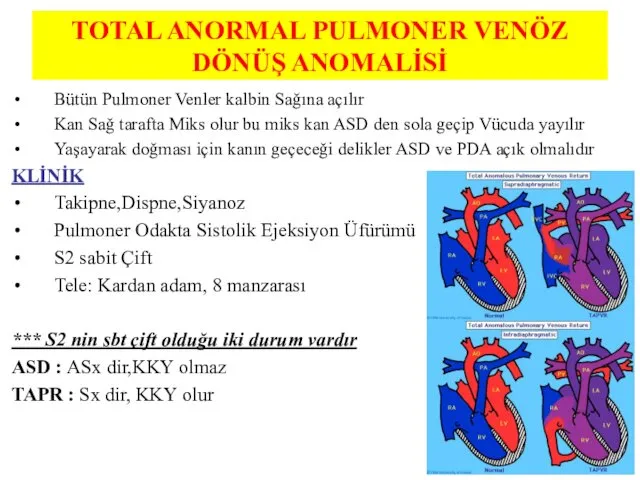 TOTAL ANORMAL PULMONER VENÖZ DÖNÜŞ ANOMALİSİ Bütün Pulmoner Venler kalbin Sağına