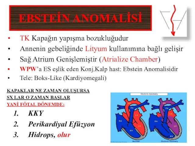 EBSTEİN ANOMALİSİ TK Kapağın yapışma bozukluğudur Annenin gebeliğinde Lityum kullanımına bağlı