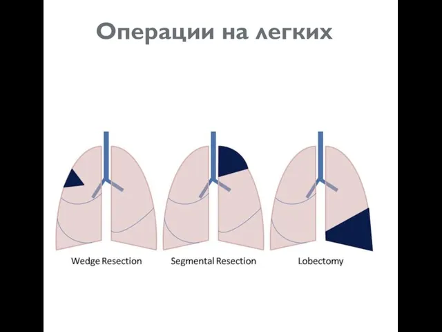 Операции на легких