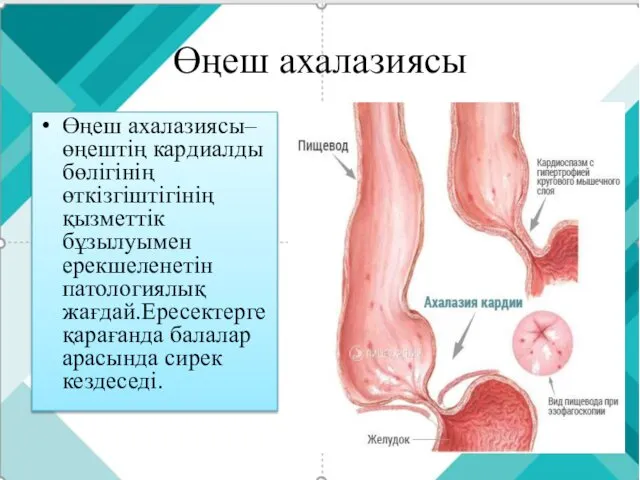 Өңеш ахалазиясы Өңеш ахалазиясы– өңештің кардиалды бөлігінің өткізгіштігінің қызметтік бұзылуымен ерекшеленетін