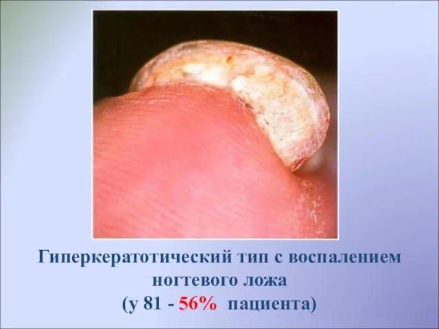 Гиперкератотический тип с воспалением ногтевого ложа (у 81 - 56% пациента)