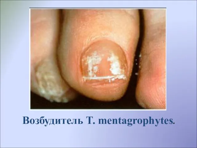 Возбудитель T. mentagrophytes.