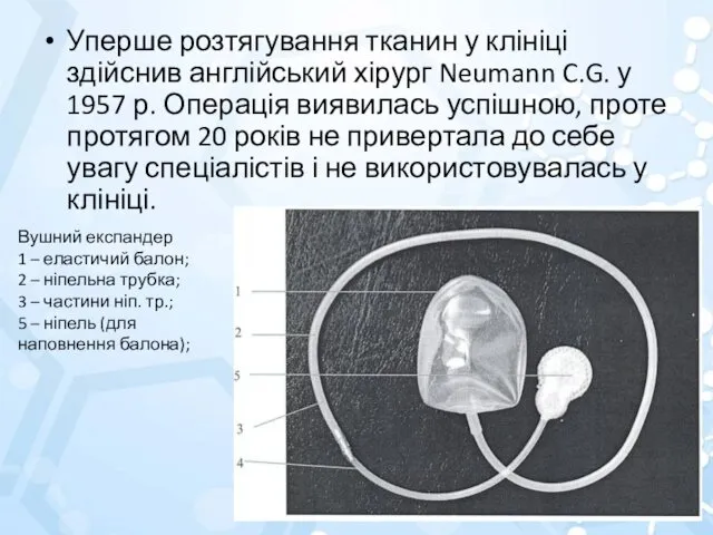 Уперше розтягування тканин у клініці здійснив англійський хірург Neumann C.G. у