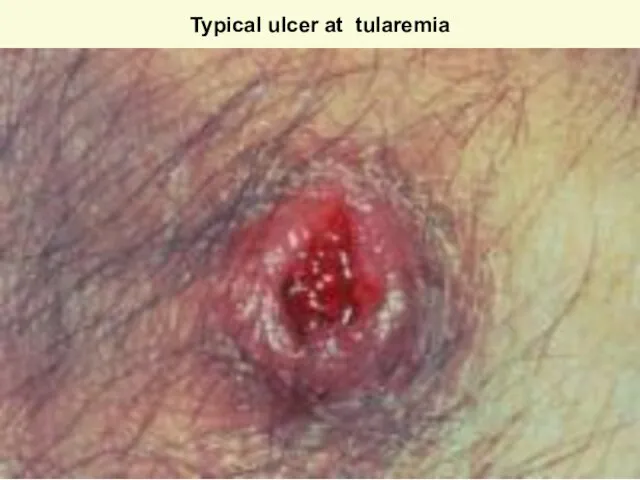 Typical ulcer at tularemia