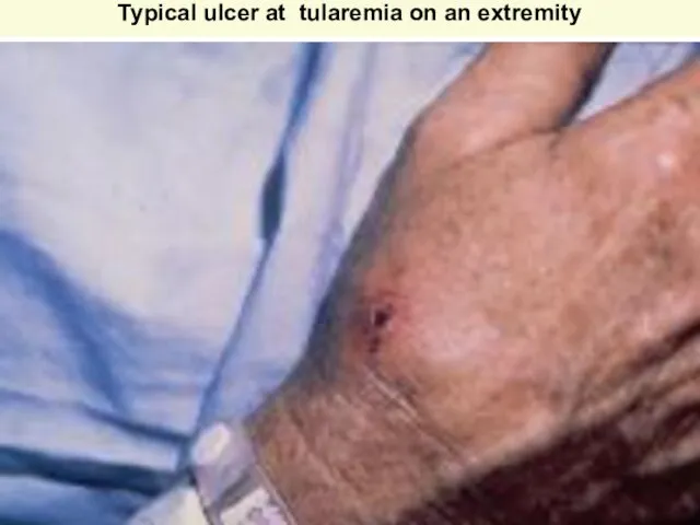 Typical ulcer at tularemia on an extremity Courtesy of Dr Hon http://www.emedicine.com/derm/topic905.htm