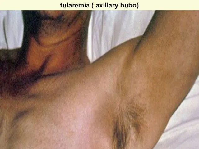 tularemia ( axillary bubo)