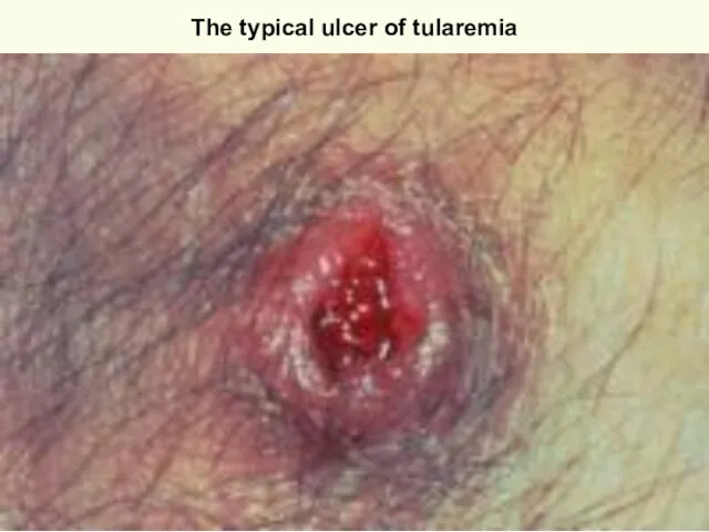 The typical ulcer of tularemia