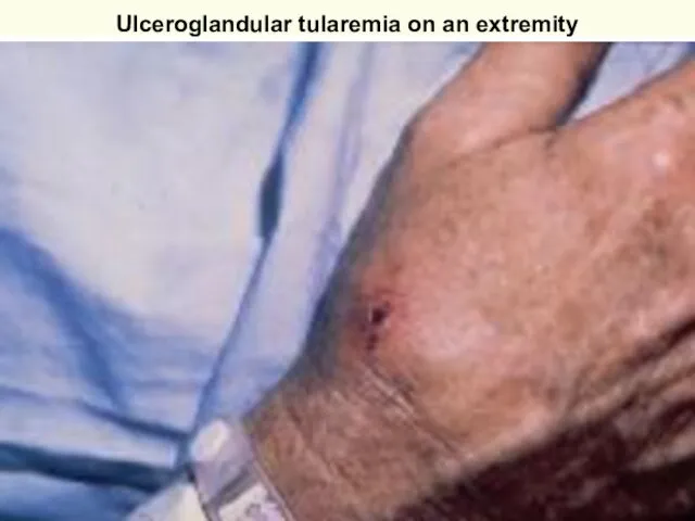 Ulceroglandular tularemia on an extremity Courtesy of Dr Hon http://www.emedicine.com/derm/topic905.htm