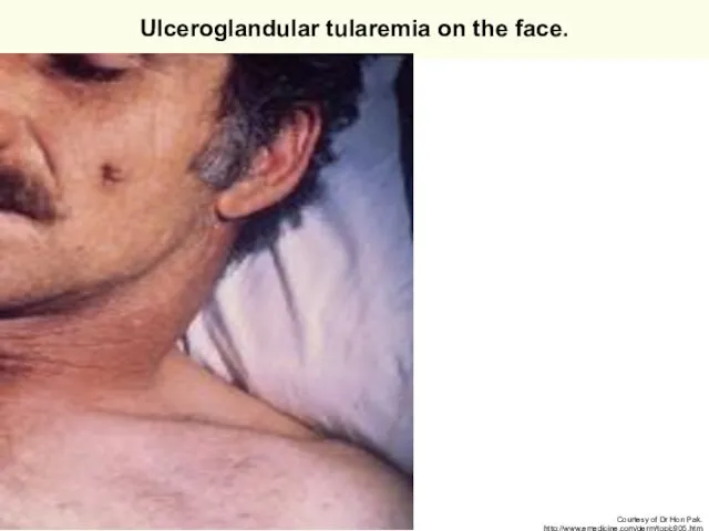 Ulceroglandular tularemia on the face. Courtesy of Dr Hon Pak. http://www.emedicine.com/derm/topic905.htm