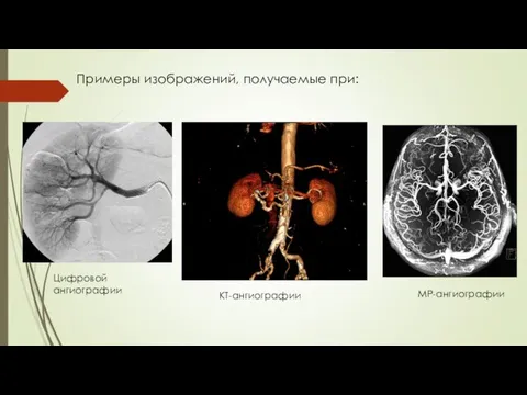 Примеры изображений, получаемые при: Цифровой ангиографии КТ-ангиографии МР-ангиографии