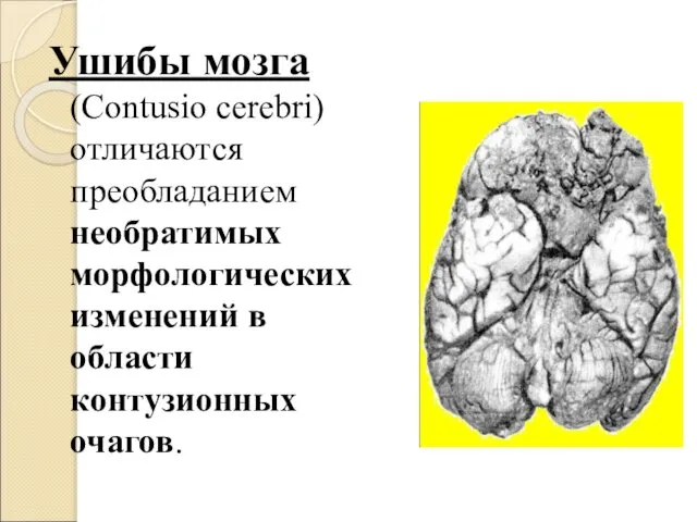 Ушибы мозга (Contusio cerebri) отличаются преобладанием необратимых морфологических изменений в области контузионных очагов.